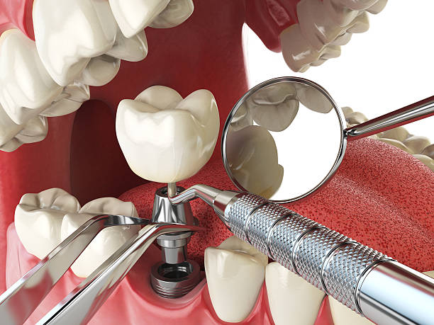 Best Broken or Chipped Tooth Repair in New Pek, IN